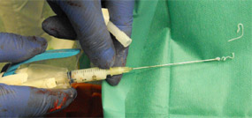 Preciquant™ Injector for surgical use